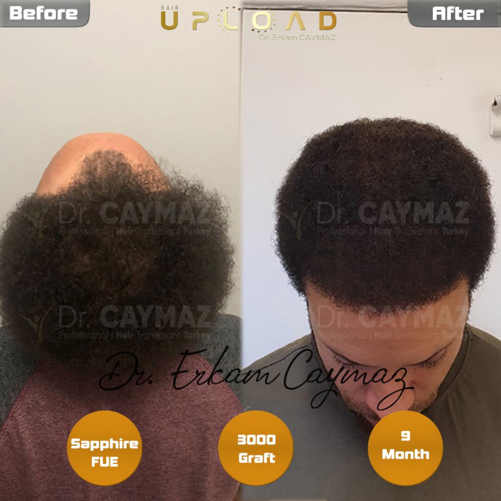 Hair transplant before & after result — frontal, 3,000 grafts, Sapphire FUE, 9 months post-op, Norwood 3 — Dr. Erkam Caymaz, Istanbul