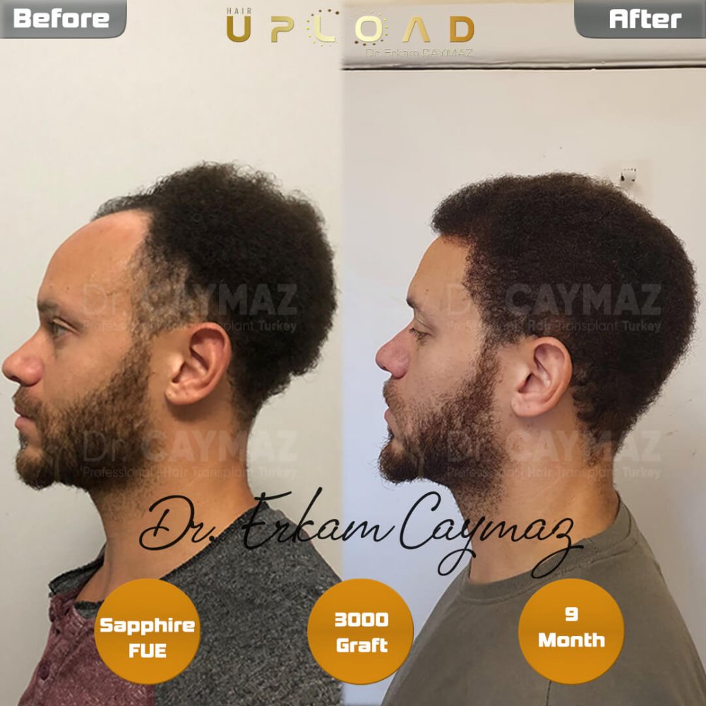 Hair transplant before & after result — frontal, 3,000 grafts, Sapphire FUE, 9 months post-op, Norwood 3 — Dr. Erkam Caymaz, Istanbul