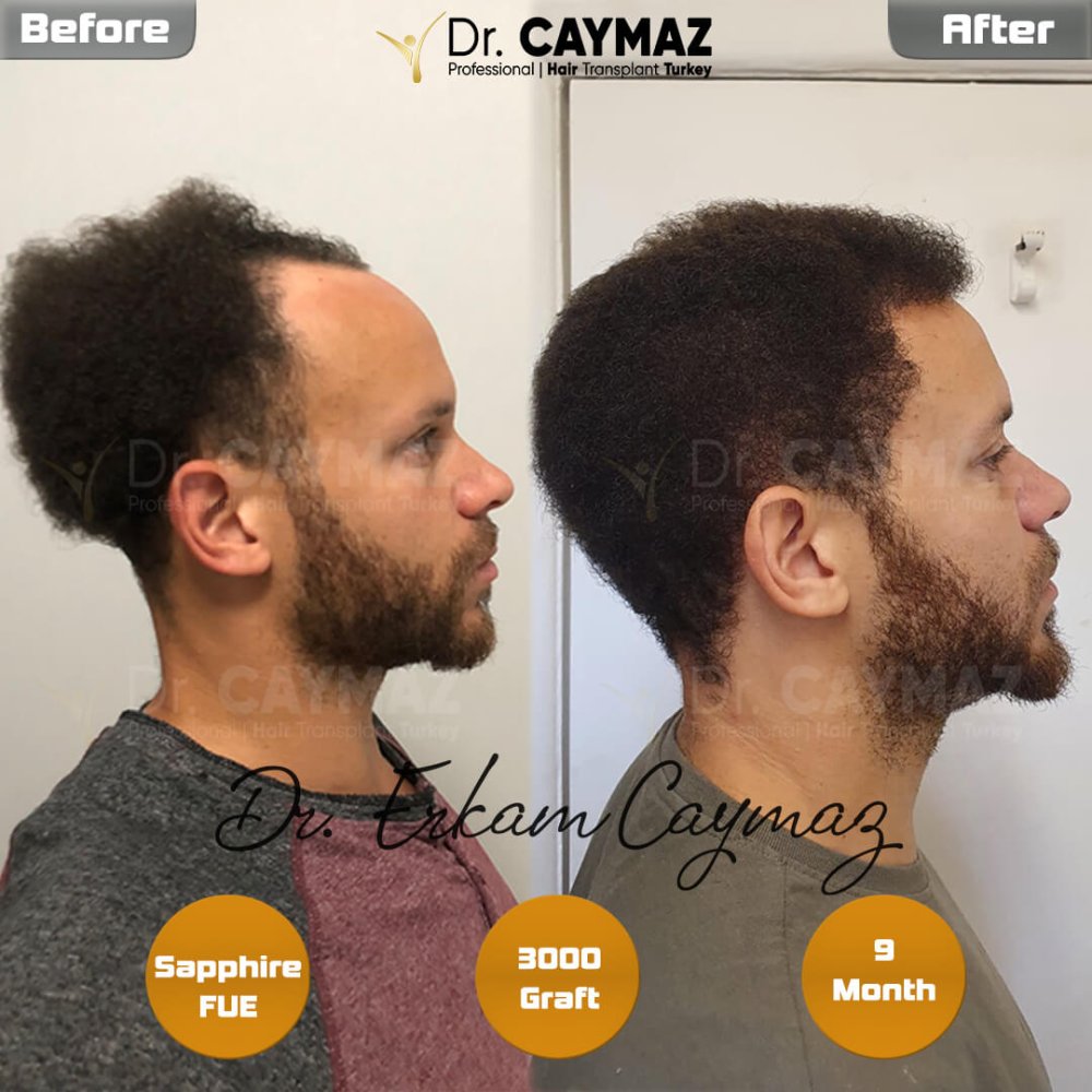 Hair transplant before & after result — frontal, 3,000 grafts, Sapphire FUE, 9 months post-op, Norwood 3 — Dr. Erkam Caymaz, Istanbul