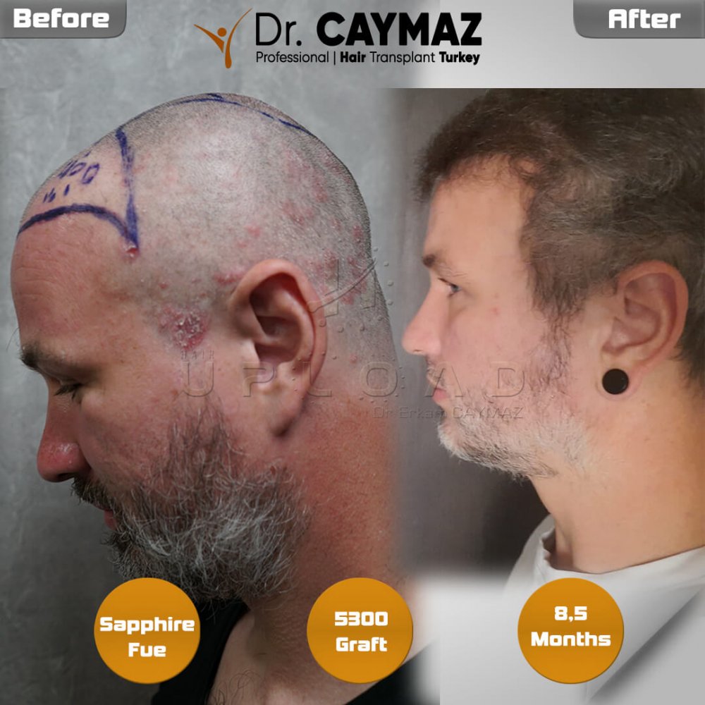 Hair transplant before & after result — frontal, top of head, crown, 5,300 grafts, Sapphire FUE, 9 months post-op, Norwood 6 — Dr. Erkam Caymaz, Istanbul