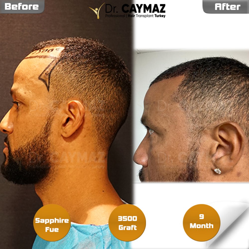 Hair transplant before & after result — frontal, kopfoberseite, 3,500 grafts, Sapphire FUE, 9 months post-op, Norwood 3 — Dr. Erkam Caymaz, Istanbul