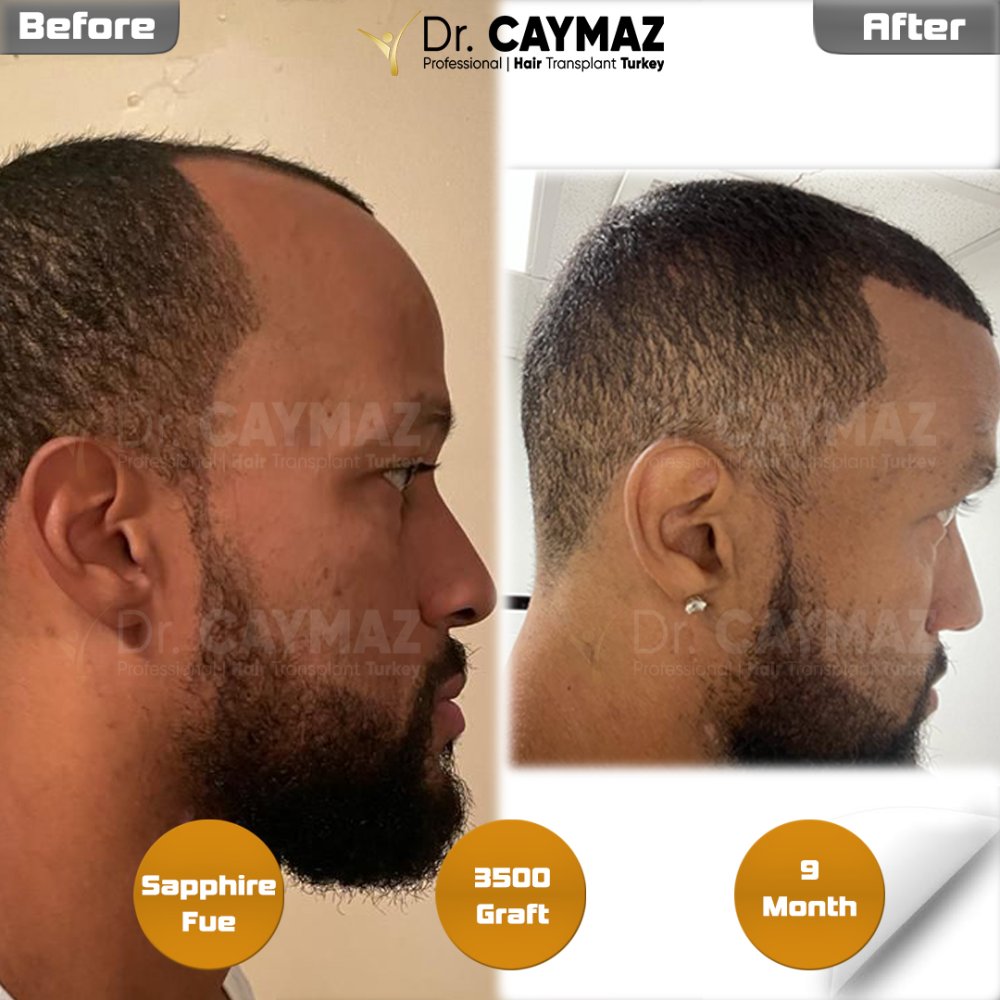 Hair transplant before & after result — frontal, kopfoberseite, 3,500 grafts, Sapphire FUE, 9 months post-op, Norwood 3 — Dr. Erkam Caymaz, Istanbul