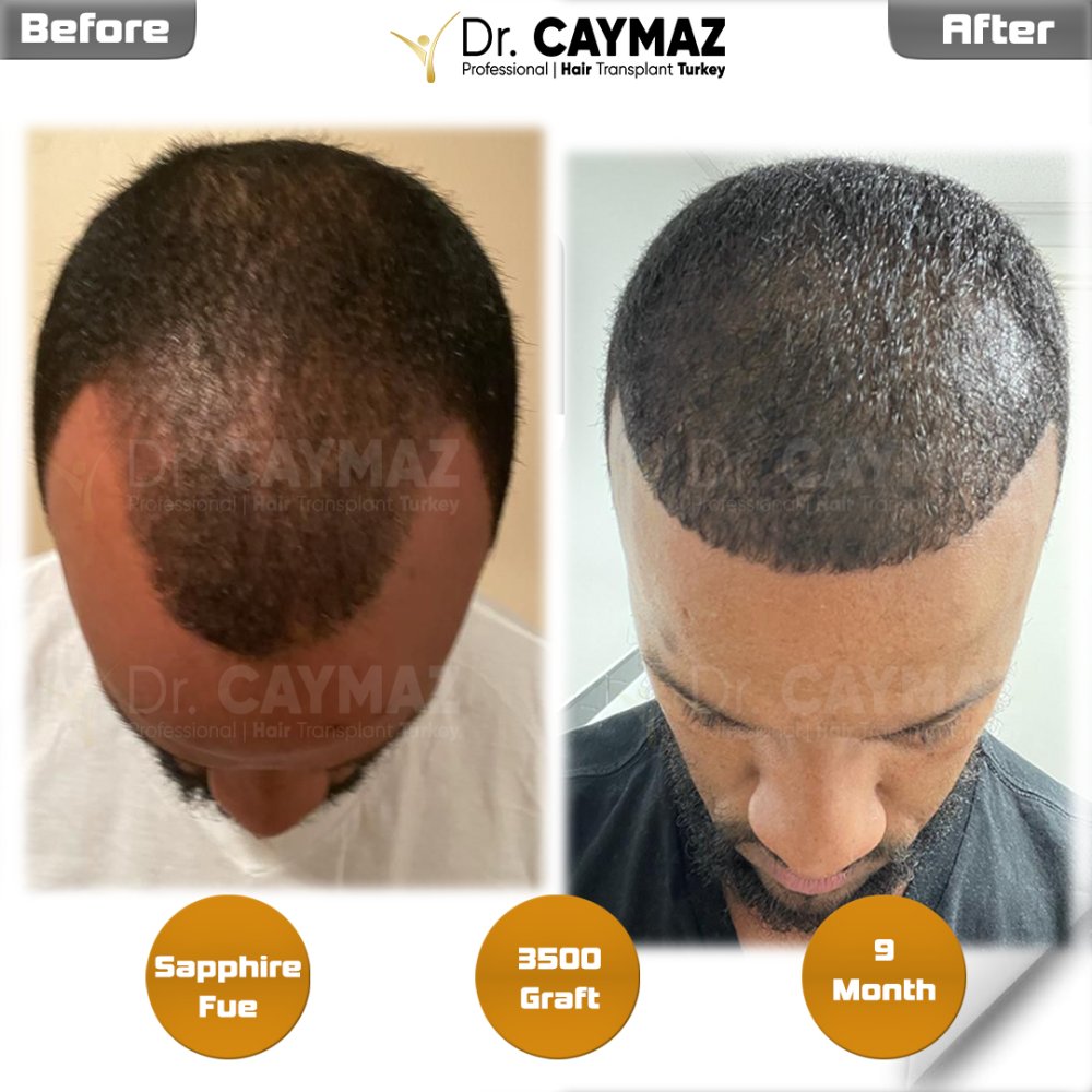 Hair transplant before & after result — frontal, kopfoberseite, 3,500 grafts, Sapphire FUE, 9 months post-op, Norwood 3 — Dr. Erkam Caymaz, Istanbul
