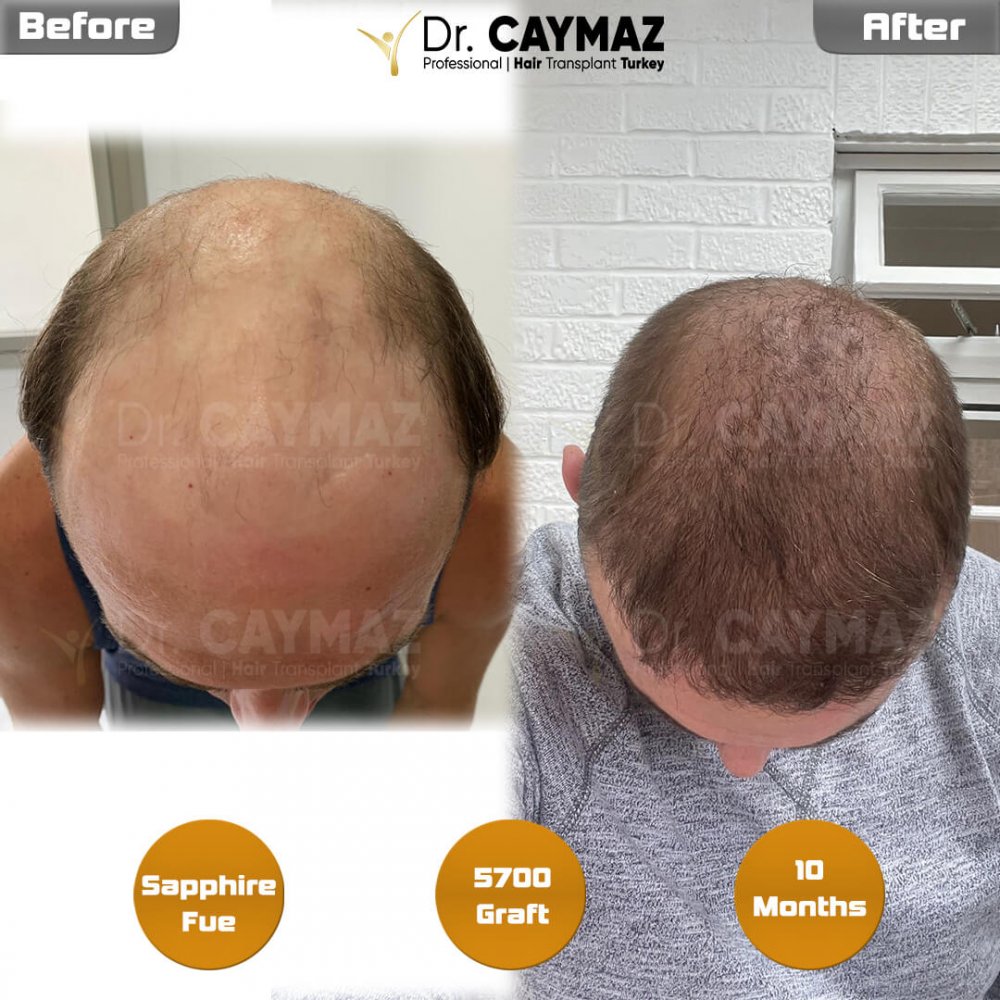 Hair transplant before & after result — frontal, top of head, crown, 5,700 grafts, Sapphire FUE, 10 months post-op, Norwood 7 — Dr. Erkam Caymaz, Istanbul