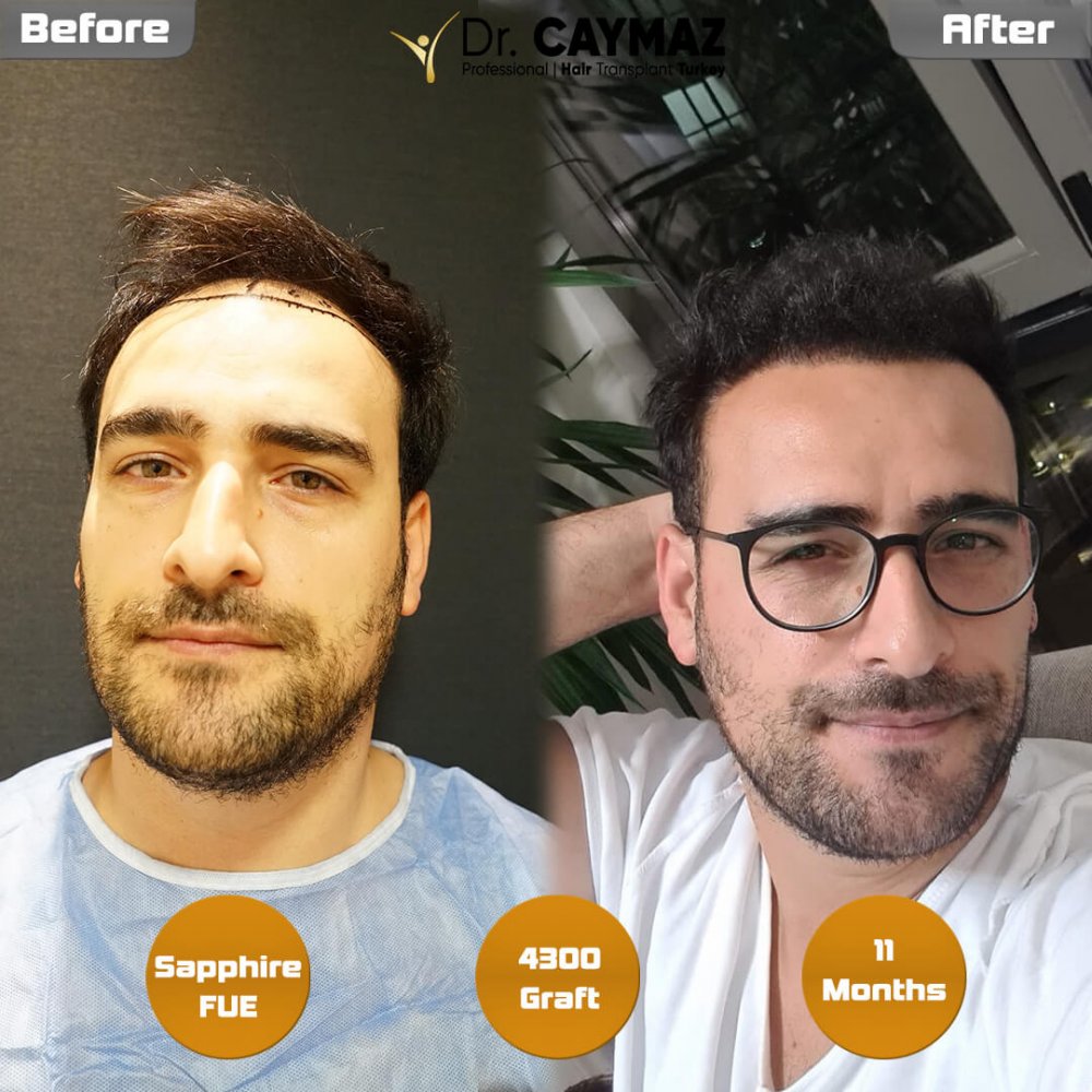 Hair transplant before & after result — frontal, top of head, 4,300 grafts, Sapphire FUE, 10 months post-op, Norwood 4 — Dr. Erkam Caymaz, Istanbul
