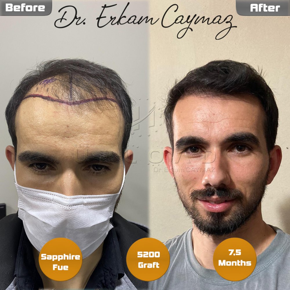 Hair transplant before & after result — frontal, parte superior, corona, 5,200 grafts, Sapphire FUE, 8 months post-op, Norwood 6 — Dr. Erkam Caymaz, Istanbul