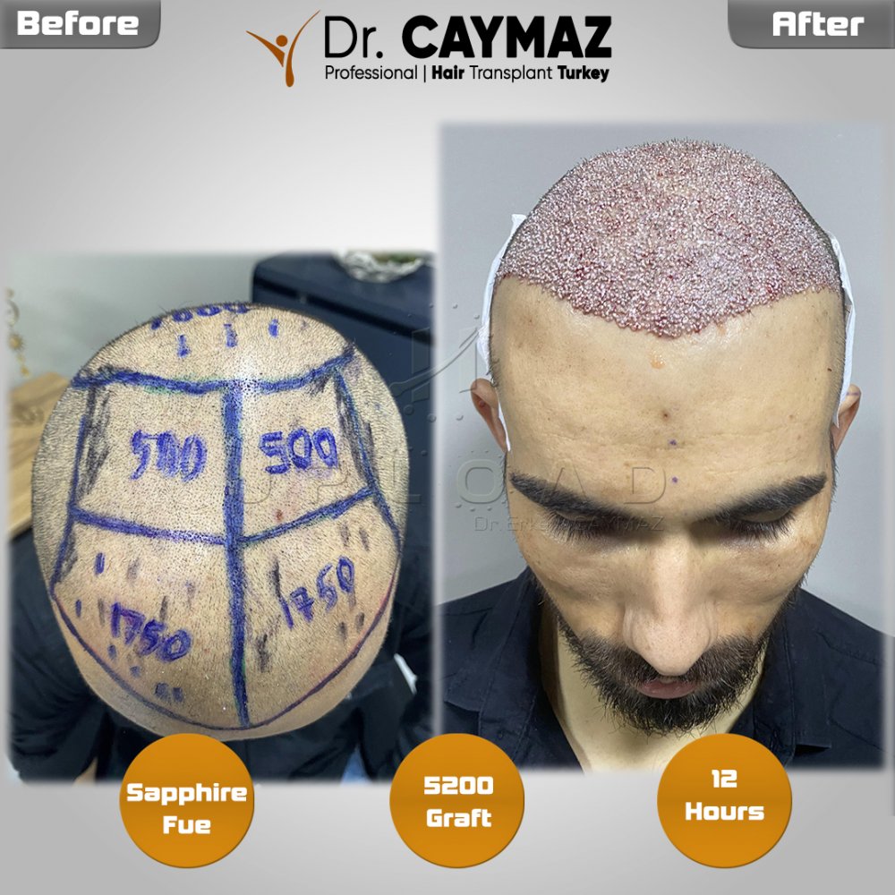 Hair transplant before & after result — frontal, parte superior, corona, 5,200 grafts, Sapphire FUE, 8 months post-op, Norwood 6 — Dr. Erkam Caymaz, Istanbul