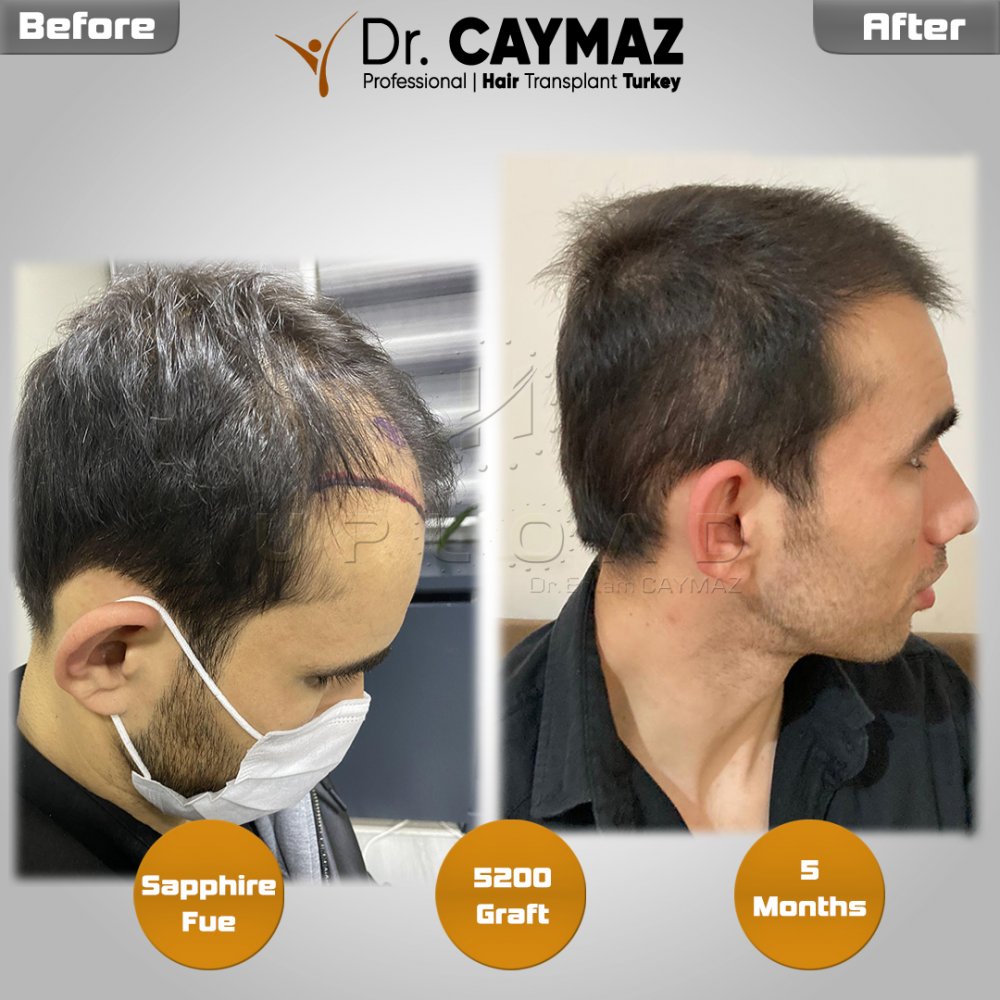 Hair transplant before & after result — frontal, parte superior, corona, 5,200 grafts, Sapphire FUE, 8 months post-op, Norwood 6 — Dr. Erkam Caymaz, Istanbul