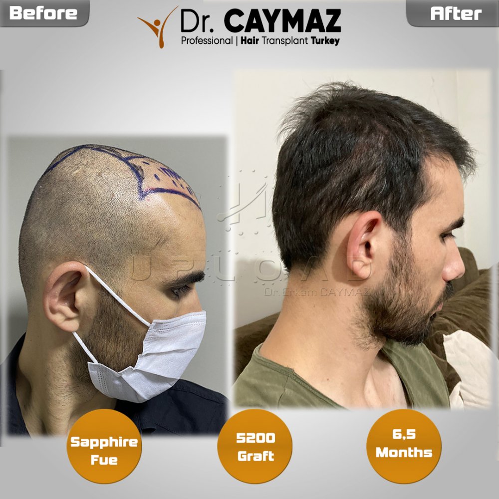 Hair transplant before & after result — frontal, parte superior, corona, 5,200 grafts, Sapphire FUE, 8 months post-op, Norwood 6 — Dr. Erkam Caymaz, Istanbul