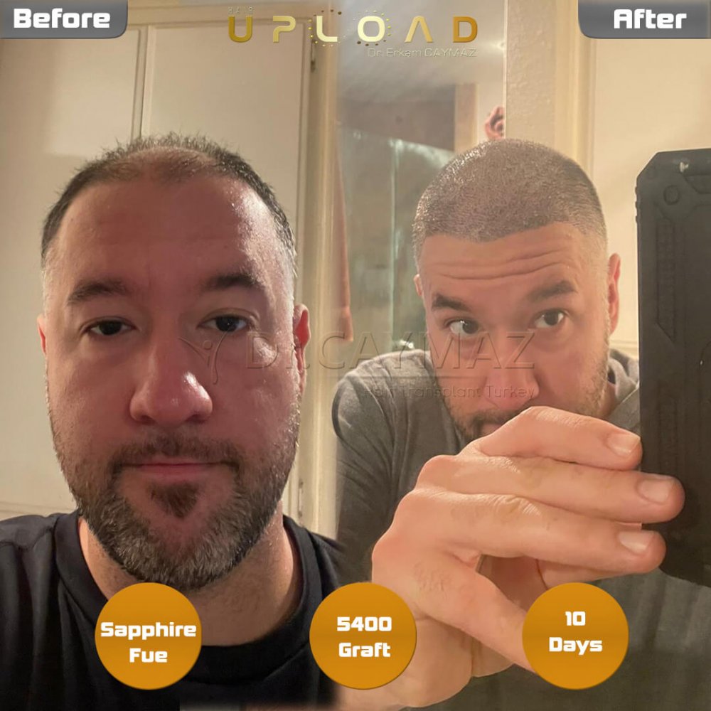Hair transplant before & after result — frontal, parte superior, corona, 5,400 grafts, Sapphire FUE, 7 months post-op, Norwood 5 — Dr. Erkam Caymaz, Istanbul