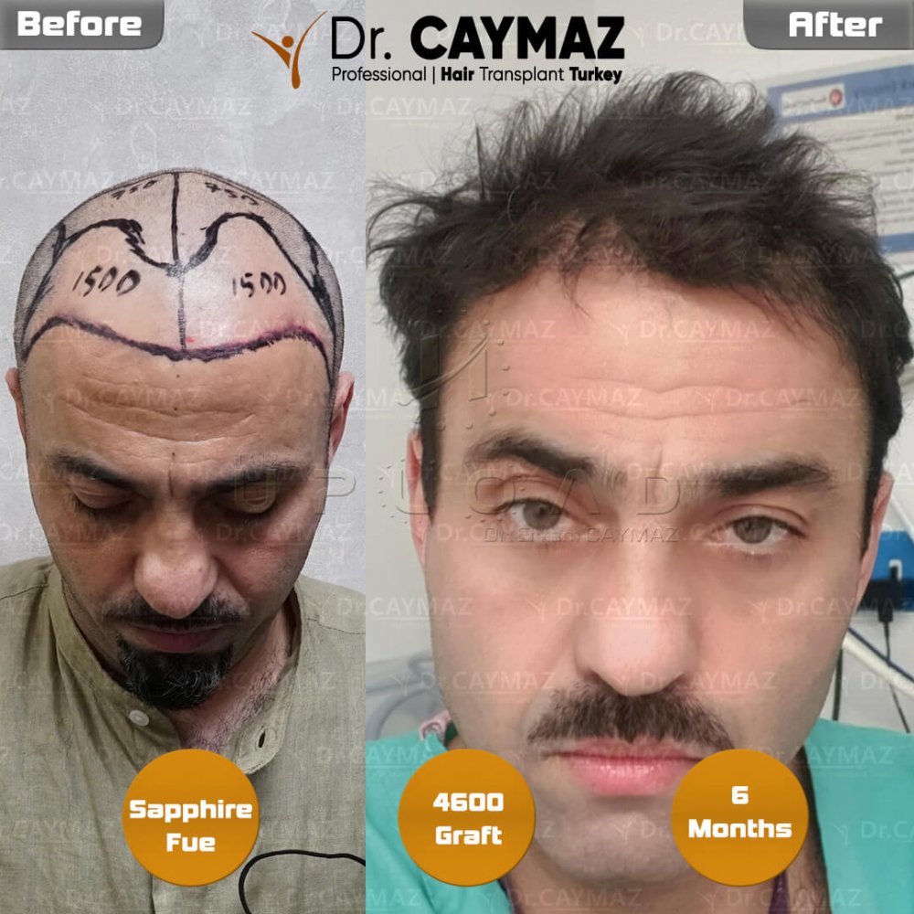 Hair transplant before & after result — frontal, parte superior, corona, 4,600 grafts, Sapphire FUE, 6 months post-op, Norwood 6 — Dr. Erkam Caymaz, Istanbul