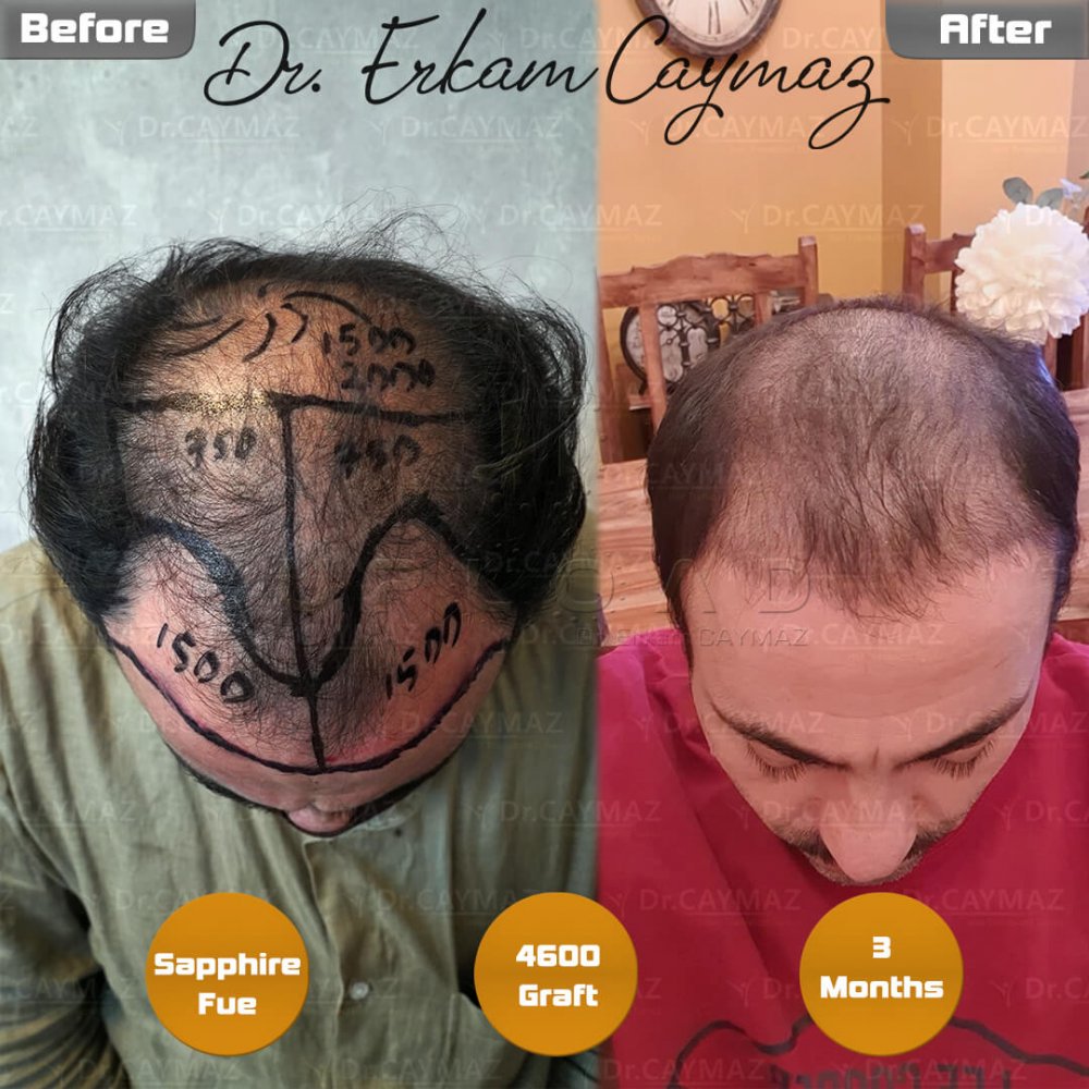 Hair transplant before & after result — frontal, parte superior, corona, 4,600 grafts, Sapphire FUE, 6 months post-op, Norwood 6 — Dr. Erkam Caymaz, Istanbul