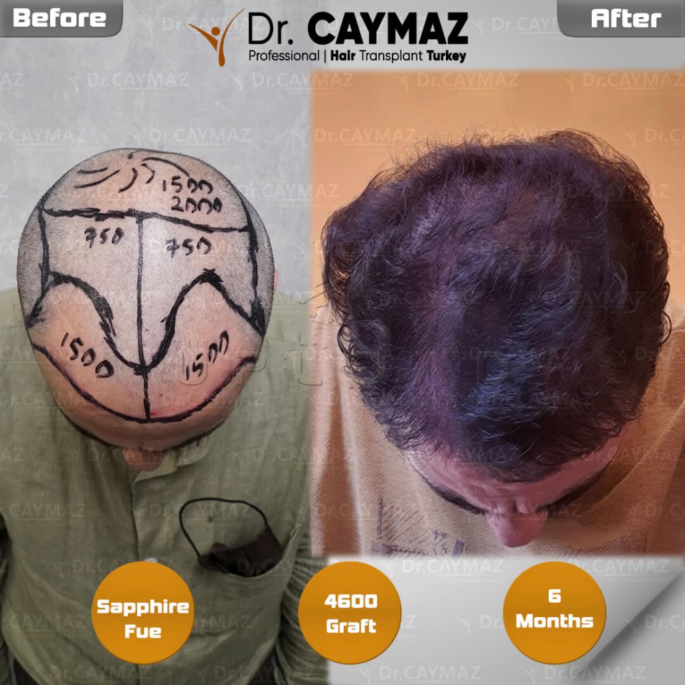 Hair transplant before & after result — frontal, parte superior, corona, 4,600 grafts, Sapphire FUE, 6 months post-op, Norwood 6 — Dr. Erkam Caymaz, Istanbul