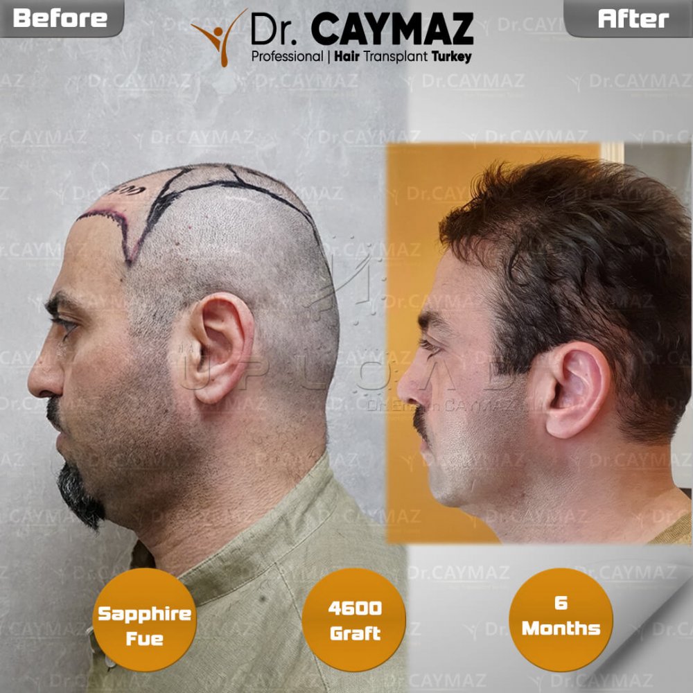 Hair transplant before & after result — frontal, parte superior, corona, 4,600 grafts, Sapphire FUE, 6 months post-op, Norwood 6 — Dr. Erkam Caymaz, Istanbul