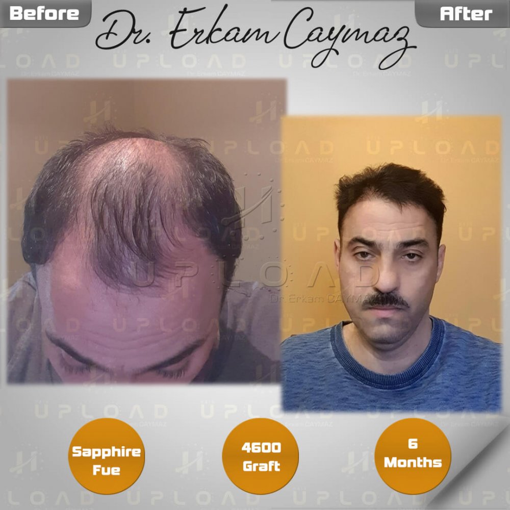 Hair transplant before & after result — frontal, parte superior, corona, 4,600 grafts, Sapphire FUE, 6 months post-op, Norwood 6 — Dr. Erkam Caymaz, Istanbul