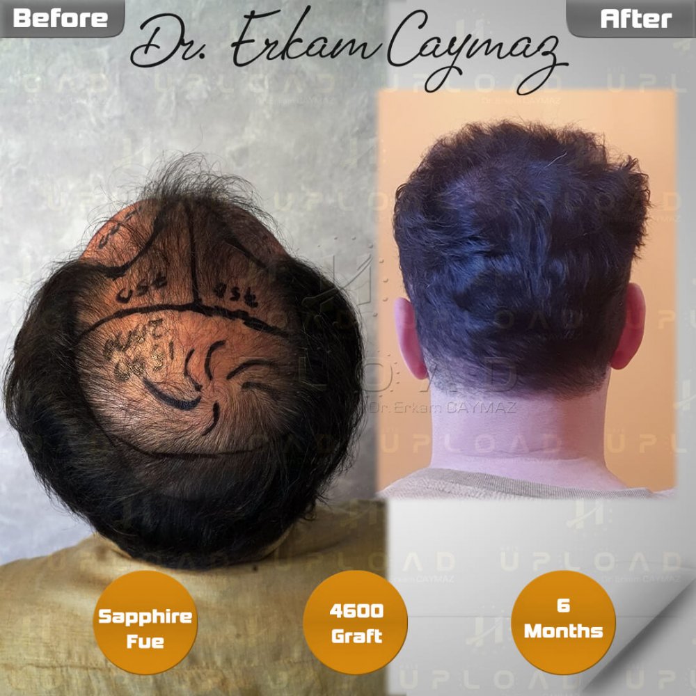 Hair transplant before & after result — frontal, parte superior, corona, 4,600 grafts, Sapphire FUE, 6 months post-op, Norwood 6 — Dr. Erkam Caymaz, Istanbul