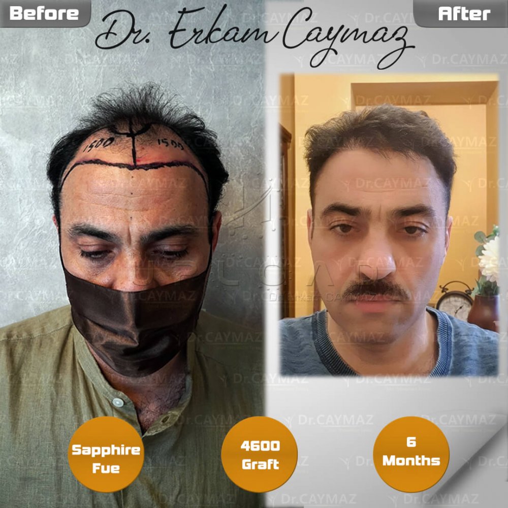 Hair transplant before & after result — frontal, parte superior, corona, 4,600 grafts, Sapphire FUE, 6 months post-op, Norwood 6 — Dr. Erkam Caymaz, Istanbul
