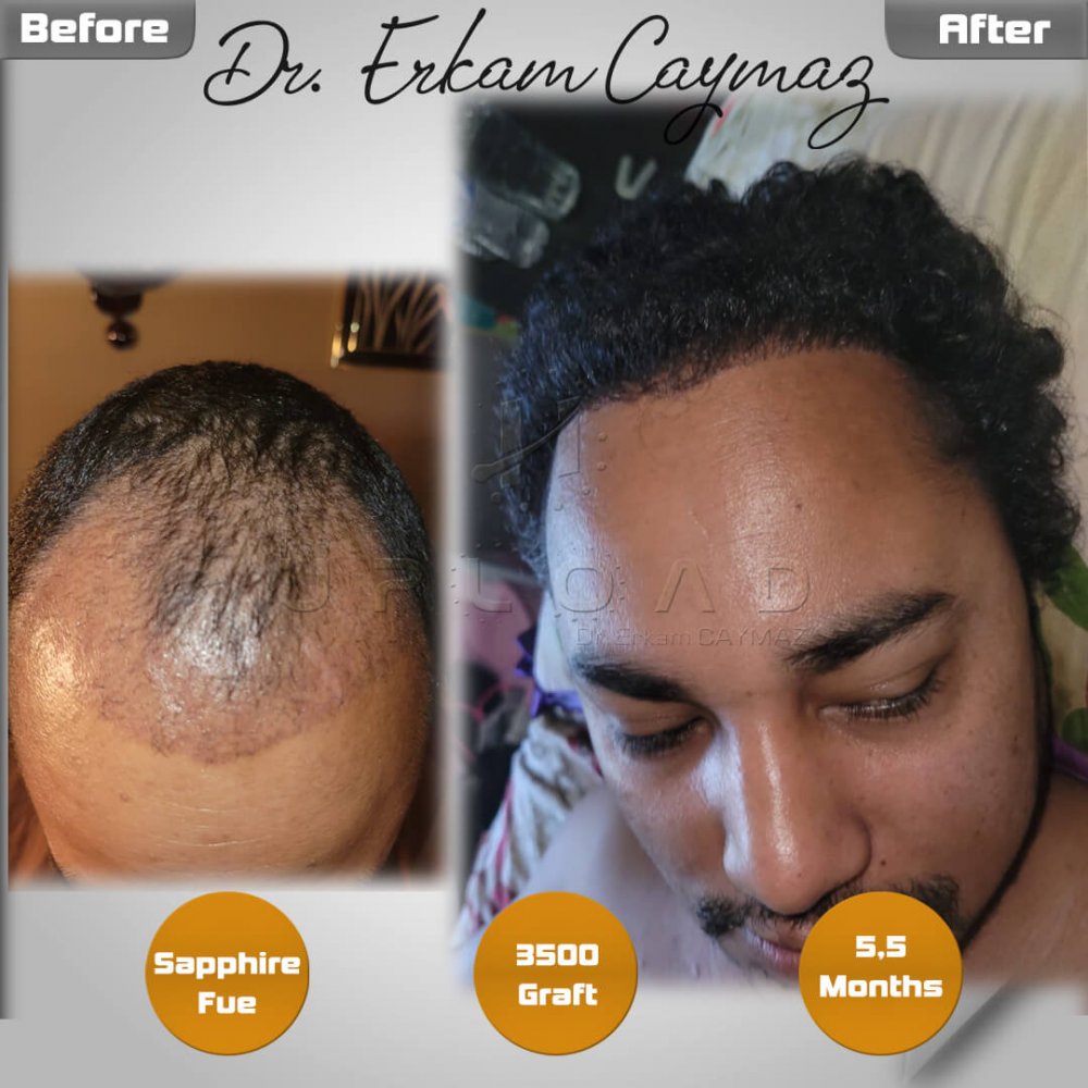 Mr. Shatir Biswa - 3500 Graft - 5,5 Months Result - Sapphire Fue - USA - Afro American — hair transplant before & after — frontal, parte superior, 3,500 grafts, Sapphire FUE, 6 months post-op, Norwood 4 — Dr. Erkam Caymaz, Istanbul