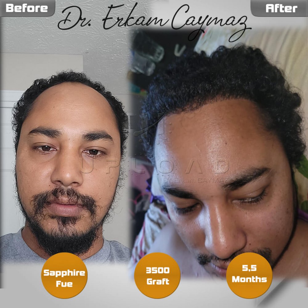 Mr. Shatir Biswa - 3500 Graft - 5,5 Months Result - Sapphire Fue - USA - Afro American — hair transplant before & after — frontal, parte superior, 3,500 grafts, Sapphire FUE, 6 months post-op, Norwood 4 — Dr. Erkam Caymaz, Istanbul