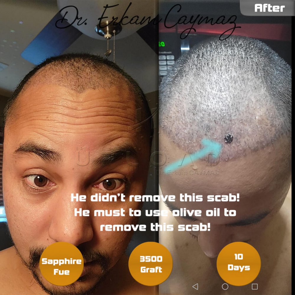Mr. Shatir Biswa - 3500 Graft - 5,5 Months Result - Sapphire Fue - USA - Afro American — hair transplant before & after — frontal, parte superior, 3,500 grafts, Sapphire FUE, 6 months post-op, Norwood 4 — Dr. Erkam Caymaz, Istanbul