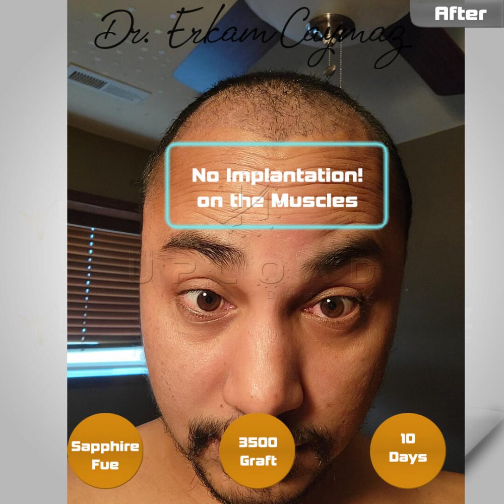 Mr. Shatir Biswa - 3500 Graft - 5,5 Months Result - Sapphire Fue - USA - Afro American — hair transplant before & after — frontal, parte superior, 3,500 grafts, Sapphire FUE, 6 months post-op, Norwood 4 — Dr. Erkam Caymaz, Istanbul