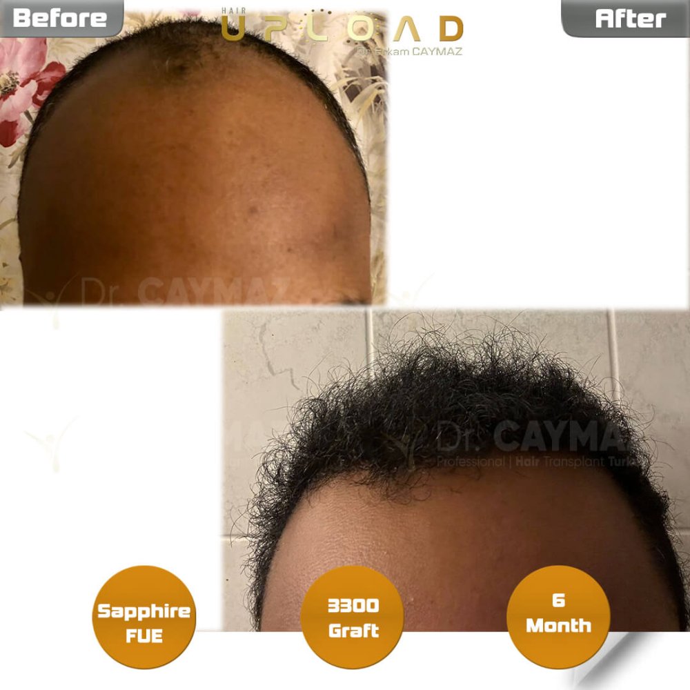 Hair transplant before & after result — frontal, schläfen, 3,300 grafts, Sapphire FUE, 6 months post-op, Norwood 3 — Dr. Erkam Caymaz, Istanbul