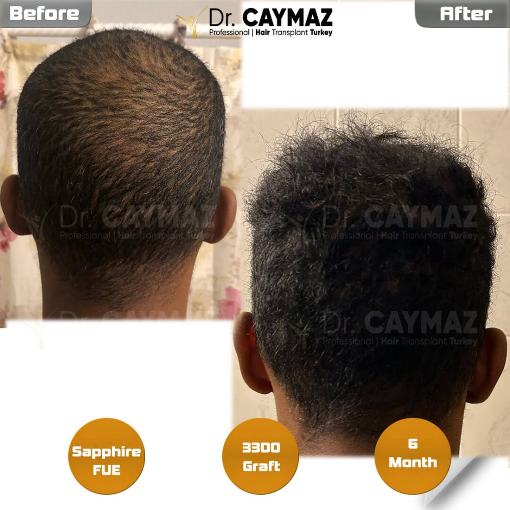 Hair transplant before & after result — frontal, schläfen, 3,300 grafts, Sapphire FUE, 6 months post-op, Norwood 3 — Dr. Erkam Caymaz, Istanbul