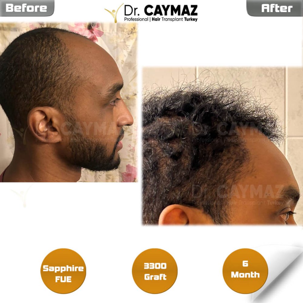 Hair transplant before & after result — frontal, schläfen, 3,300 grafts, Sapphire FUE, 6 months post-op, Norwood 3 — Dr. Erkam Caymaz, Istanbul