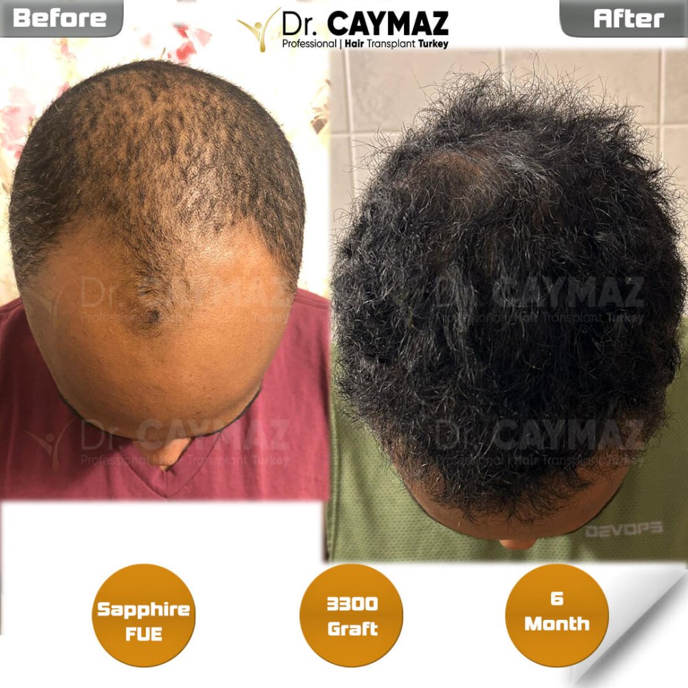Hair transplant before & after result — frontal, schläfen, 3,300 grafts, Sapphire FUE, 6 months post-op, Norwood 3 — Dr. Erkam Caymaz, Istanbul