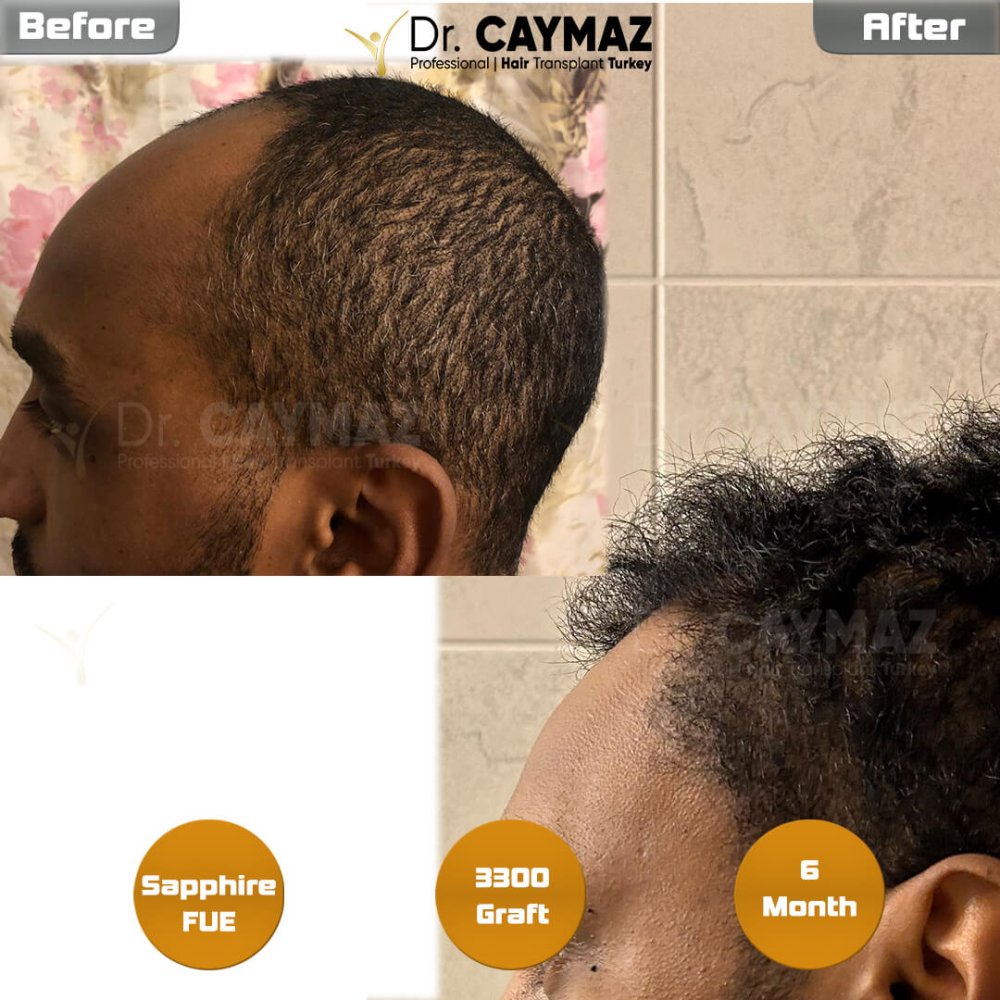 Hair transplant before & after result — frontal, schläfen, 3,300 grafts, Sapphire FUE, 6 months post-op, Norwood 3 — Dr. Erkam Caymaz, Istanbul