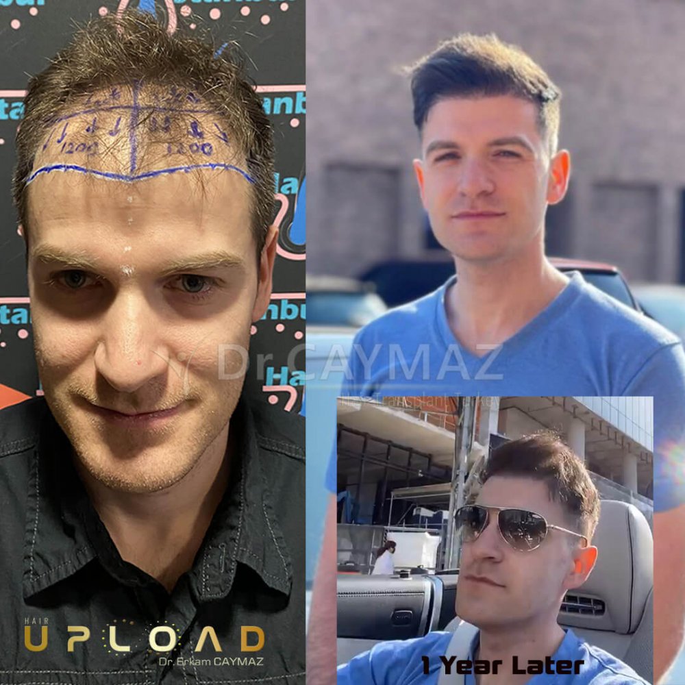 Hair transplant before & after result — frontal, parte superior, 4,650 grafts, Sapphire FUE, 18 months post-op, Norwood 4 — Dr. Erkam Caymaz, Istanbul