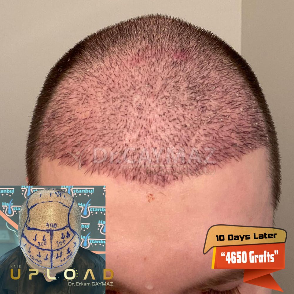 Hair transplant before & after result — frontal, parte superior, 4,650 grafts, Sapphire FUE, 18 months post-op, Norwood 4 — Dr. Erkam Caymaz, Istanbul