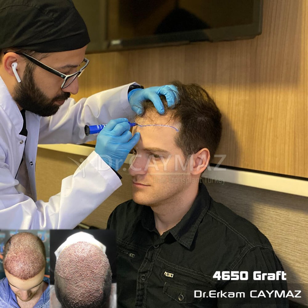Hair transplant before & after result — frontal, parte superior, 4,650 grafts, Sapphire FUE, 18 months post-op, Norwood 4 — Dr. Erkam Caymaz, Istanbul