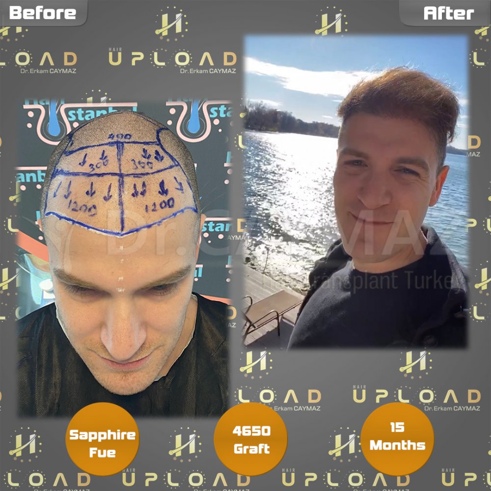 Hair transplant before & after result — frontal, parte superior, 4,650 grafts, Sapphire FUE, 18 months post-op, Norwood 4 — Dr. Erkam Caymaz, Istanbul