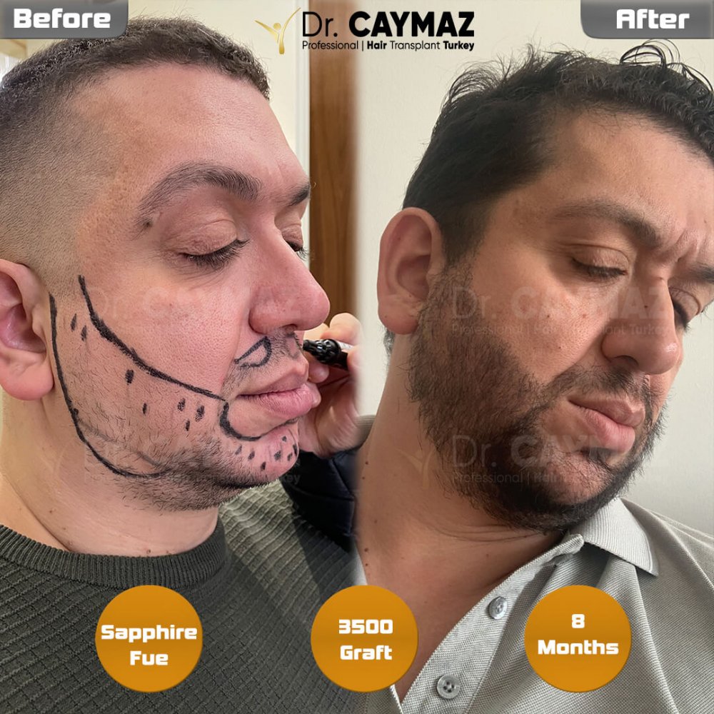 Mr. Tamer - Beard Result - 8 - months - 3500 Graft - Sapphire Incision — hair transplant before & after — beard, 3,500 grafts, Sapphire FUE, 8 months post-op — Dr. Erkam Caymaz, Istanbul