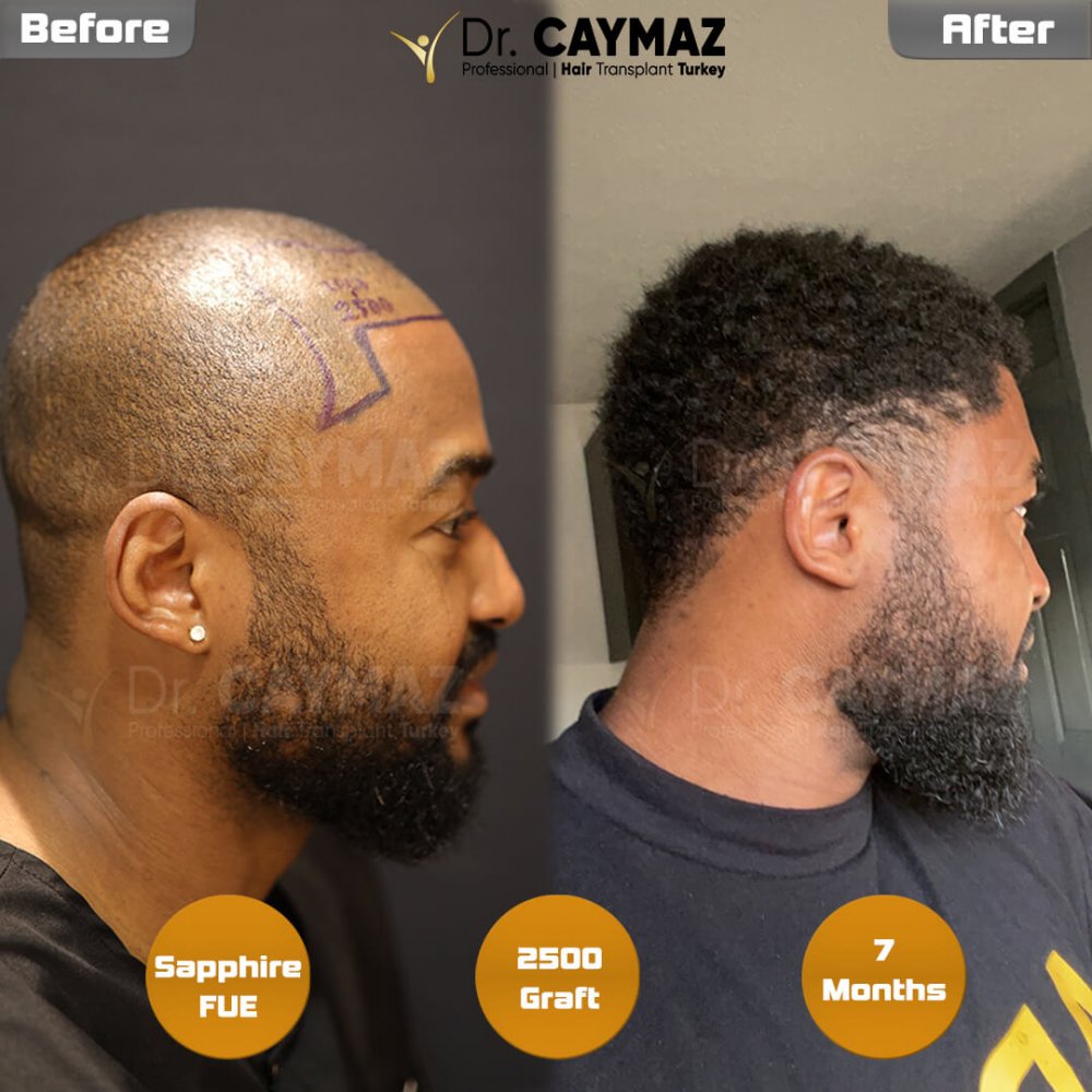 Hair transplant before & after result — frontal, schläfen, 2,500 grafts, Sapphire FUE, 7 months post-op, Norwood 2 — Dr. Erkam Caymaz, Istanbul