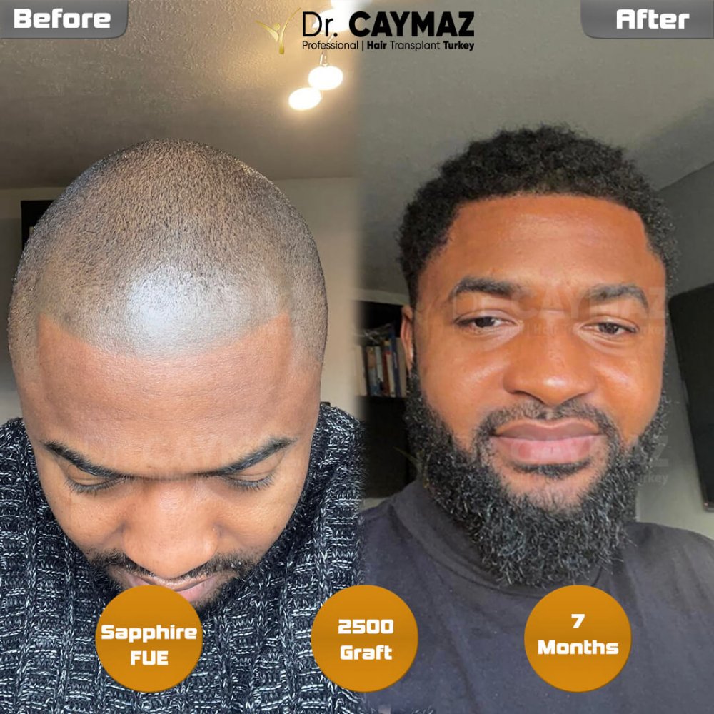 Hair transplant before & after result — frontal, schläfen, 2,500 grafts, Sapphire FUE, 7 months post-op, Norwood 2 — Dr. Erkam Caymaz, Istanbul