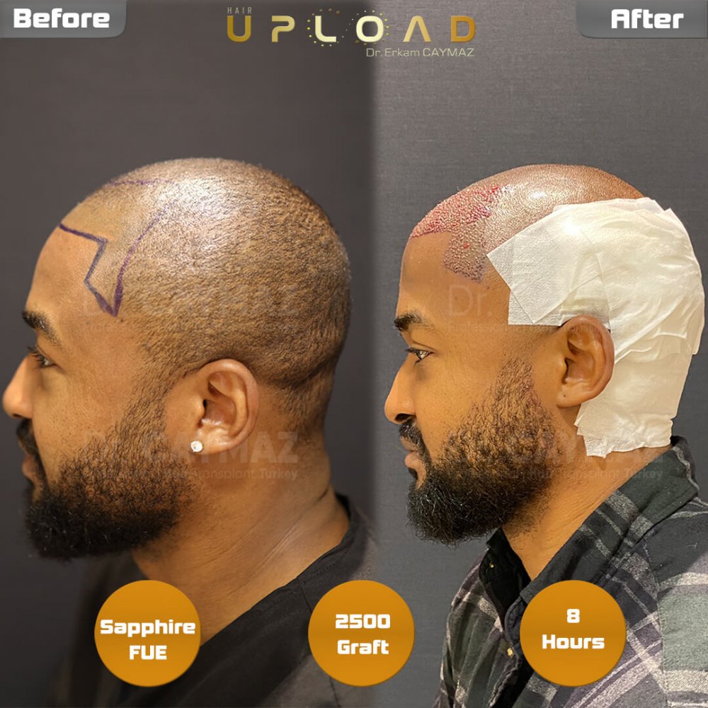 Hair transplant before & after result — frontal, schläfen, 2,500 grafts, Sapphire FUE, 7 months post-op, Norwood 2 — Dr. Erkam Caymaz, Istanbul