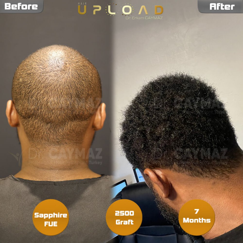 Hair transplant before & after result — frontal, schläfen, 2,500 grafts, Sapphire FUE, 7 months post-op, Norwood 2 — Dr. Erkam Caymaz, Istanbul