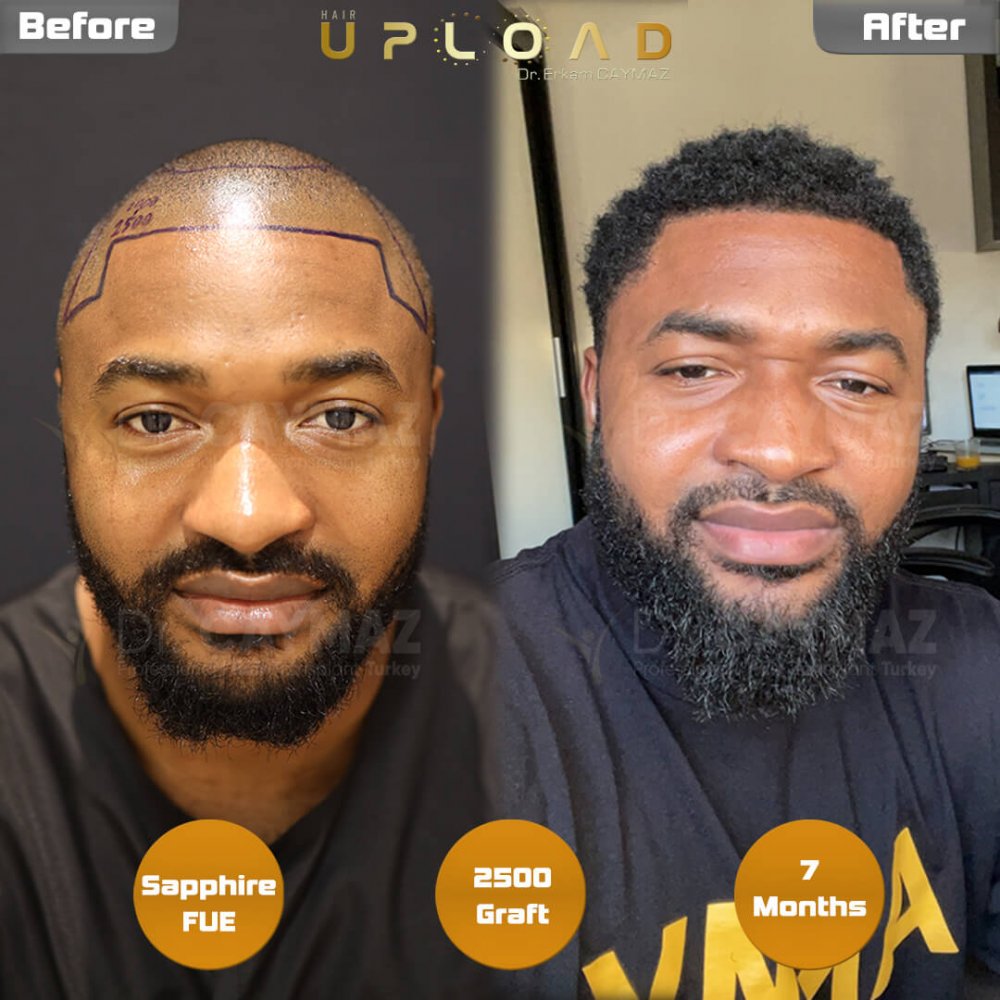 Hair transplant before & after result — frontal, schläfen, 2,500 grafts, Sapphire FUE, 7 months post-op, Norwood 2 — Dr. Erkam Caymaz, Istanbul