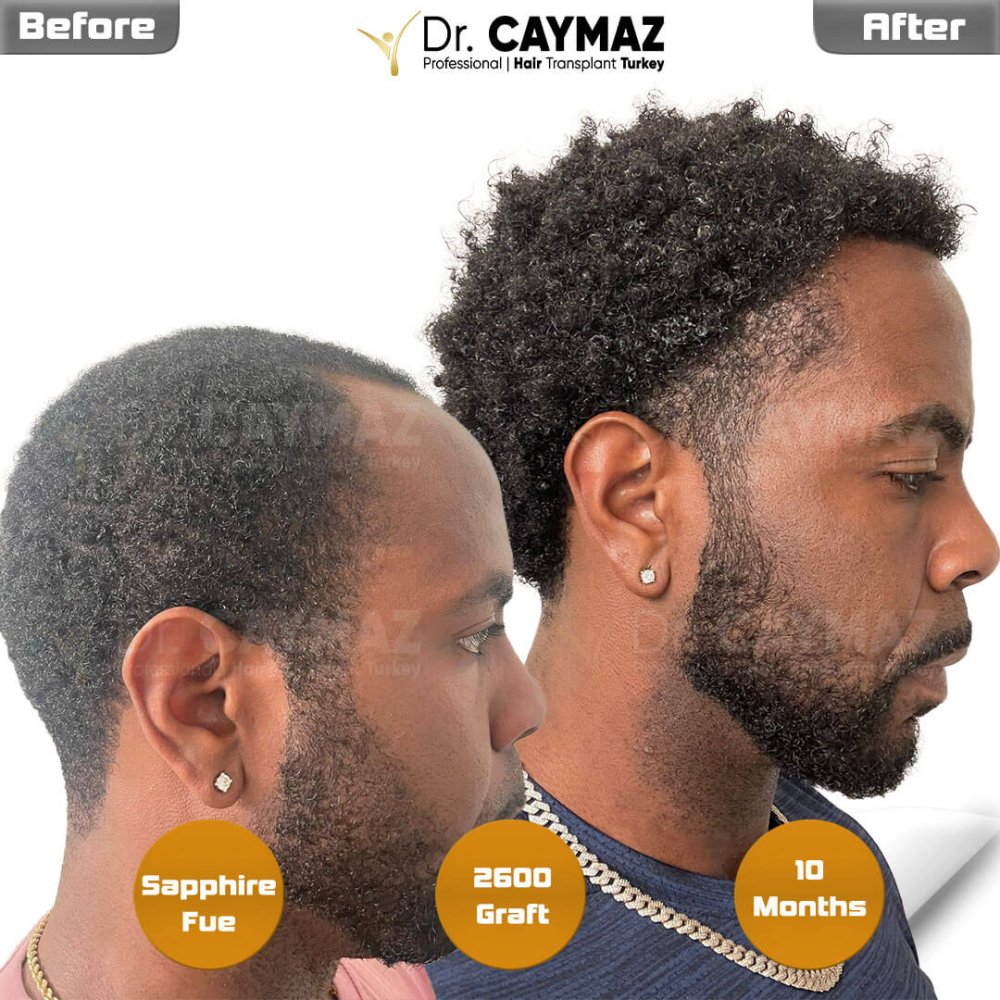 Mr.Williams - 2600 graft - 10 Months - Afro American Result — hair transplant before & after — frontal, schläfen, 2,600 grafts, Sapphire FUE, 10 months post-op, Norwood 2 — Dr. Erkam Caymaz, Istanbul