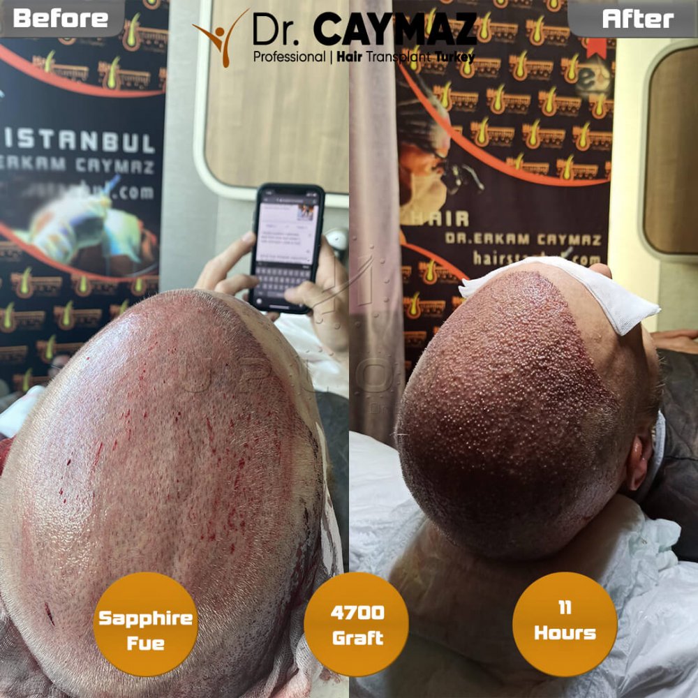 Hair transplant before & after result — frontal, top of head, temples, crown, 4,700 grafts, Sapphire FUE, 9 months post-op, Norwood 5 — Dr. Erkam Caymaz, Istanbul