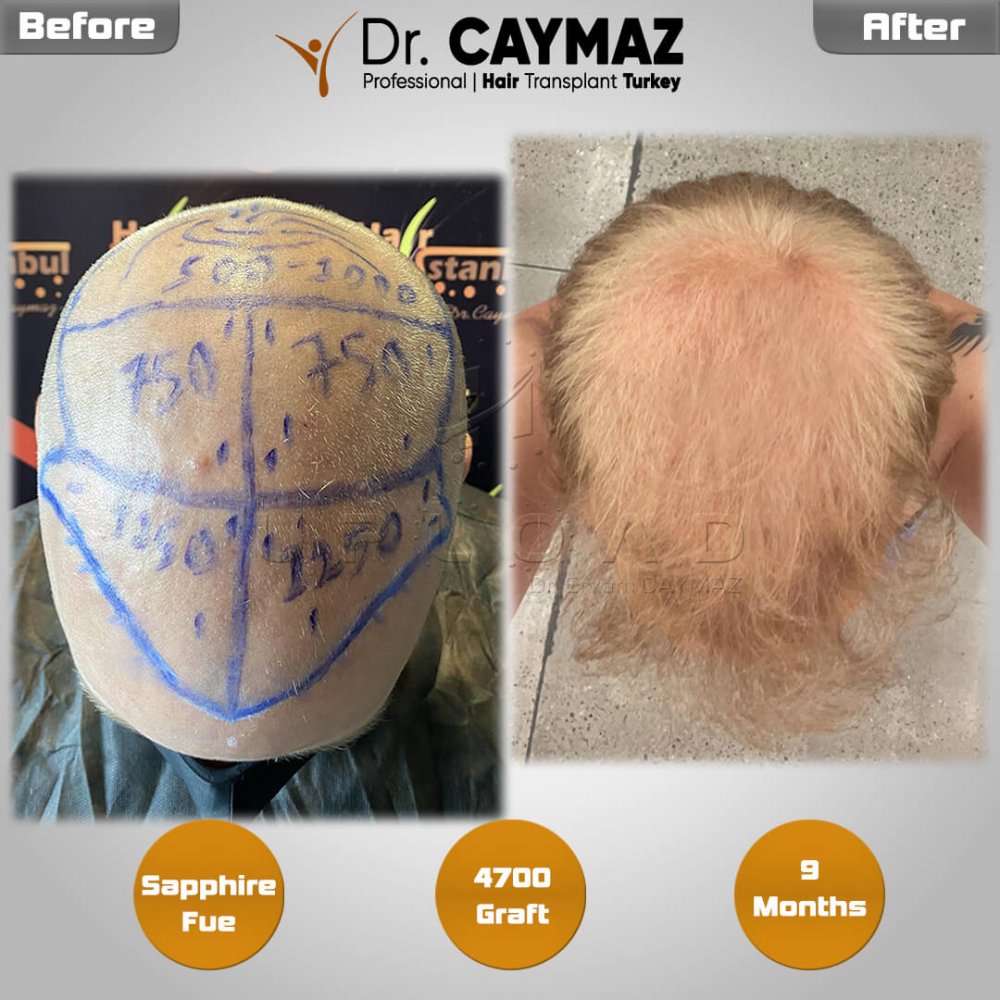 Hair transplant before & after result — frontal, top of head, temples, crown, 4,700 grafts, Sapphire FUE, 9 months post-op, Norwood 5 — Dr. Erkam Caymaz, Istanbul