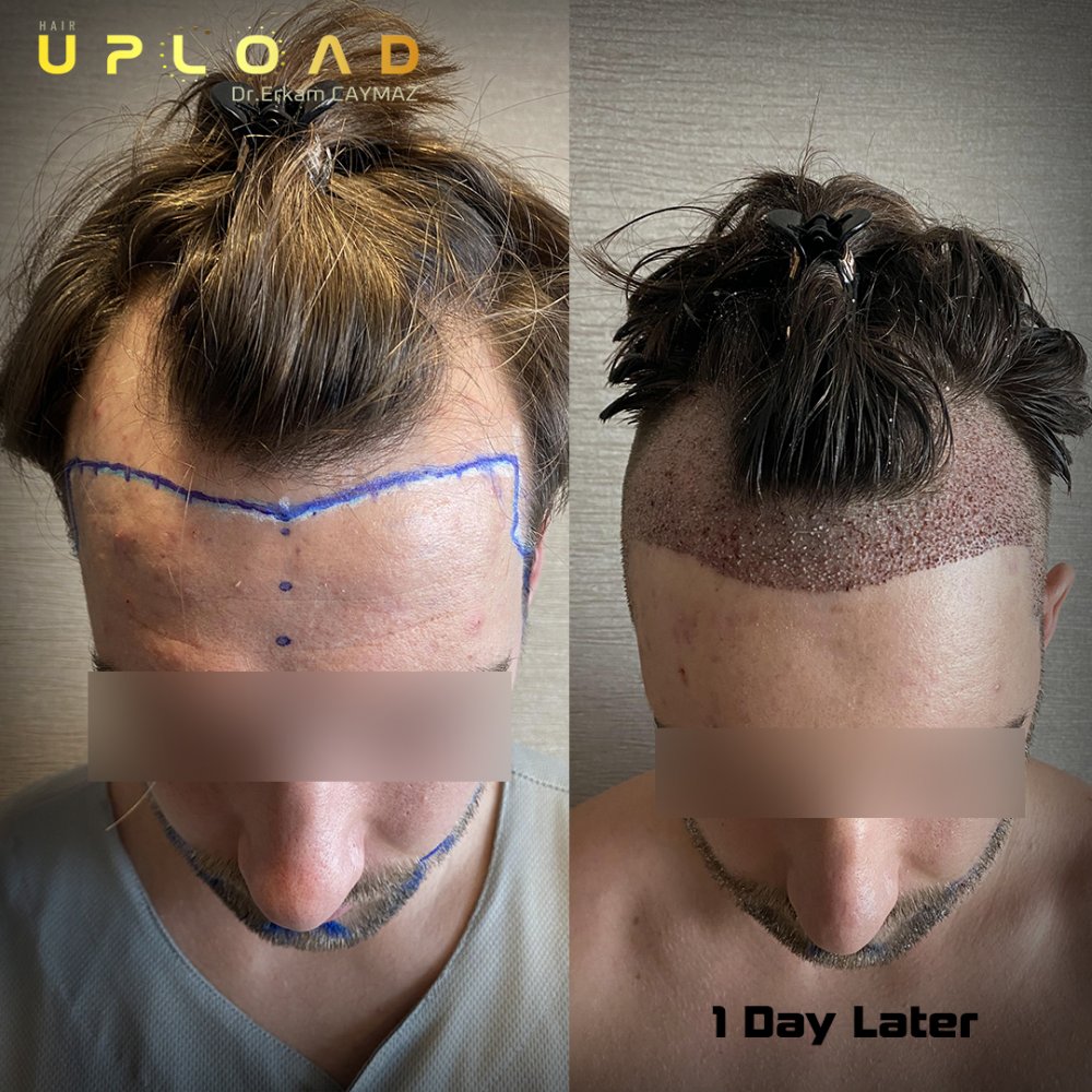 Hair transplant before & after result — frontal, 4,000 grafts, Sapphire FUE, 5 months post-op, Norwood 3 — Dr. Erkam Caymaz, Istanbul