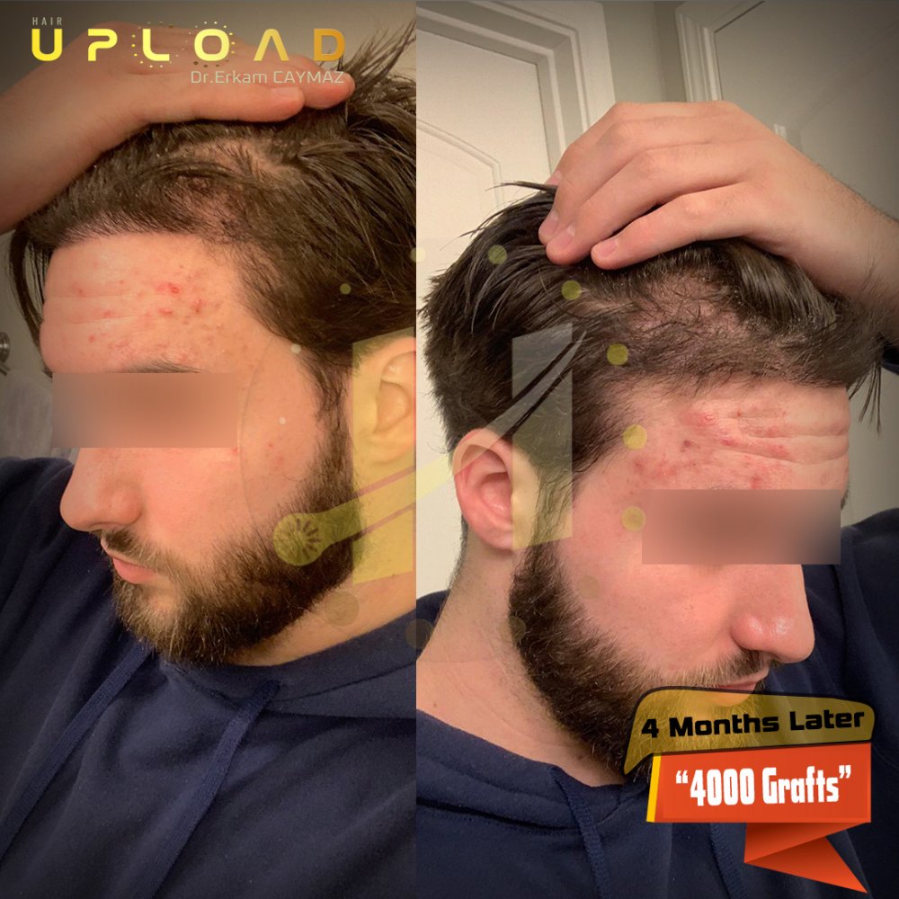 Hair transplant before & after result — frontal, 4,000 grafts, Sapphire FUE, 5 months post-op, Norwood 3 — Dr. Erkam Caymaz, Istanbul