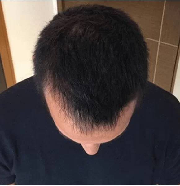 Hair transplant after result — Dr. Erkam Caymaz Istanbul