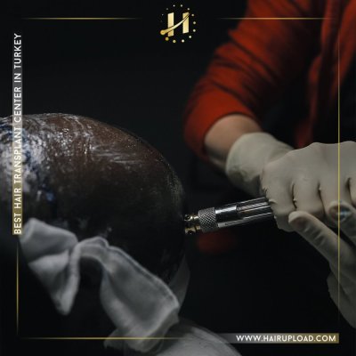 Bekannte Fehler bei der Haartransplantation