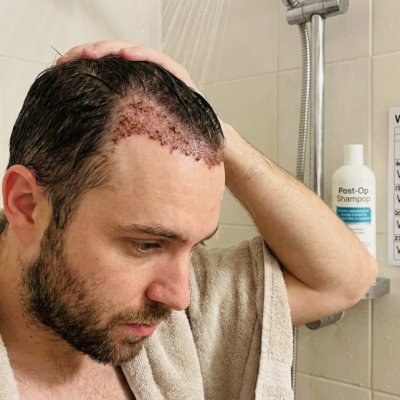 Return-to-Activity Calendar After Hair Transplant cover