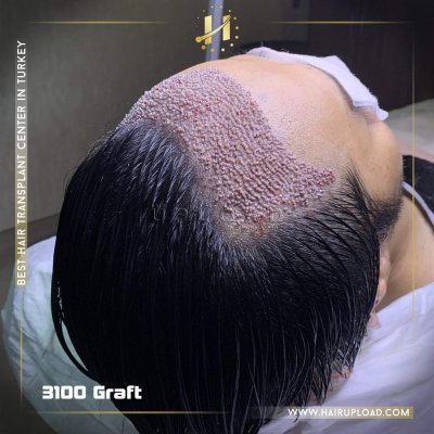 Haartransplantation und die Wirkung von Kopfhautgewebe