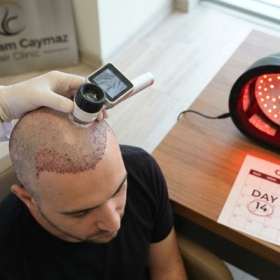 Laserkappe nach FUE-Haartransplantation: Timing-Guide-Abdeckung